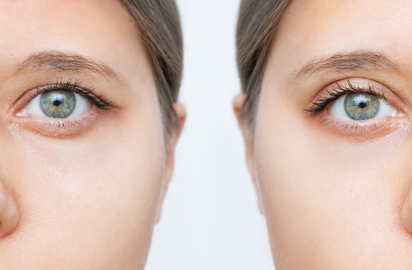 Blefaroplastika - plastická operace očních víček